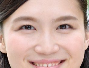 二重まぶた加工前